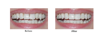 Best Dental Crowns Treatment In Berwick - Woodleigh Waters Dental Surgery